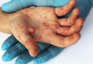 Επισκέπτες Υγείας: Αναγκαίες δράσεις με αφορμή την έξαρση ιλαράς