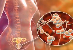 Candida spp. και Γυναικολογική Υγεία: Αντιμετώπιση της Κολπικής Μυκητίασης